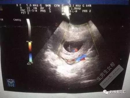 「独家」孕囊形状可以看男女？孕妈们都讨论疯了，靠谱吗？