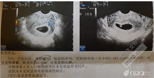 孕囊,孕囊大小对照表,怀孕50天孕囊大小,孕囊看男女