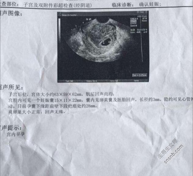 孕囊看男女！据说很准！教你怎么看！