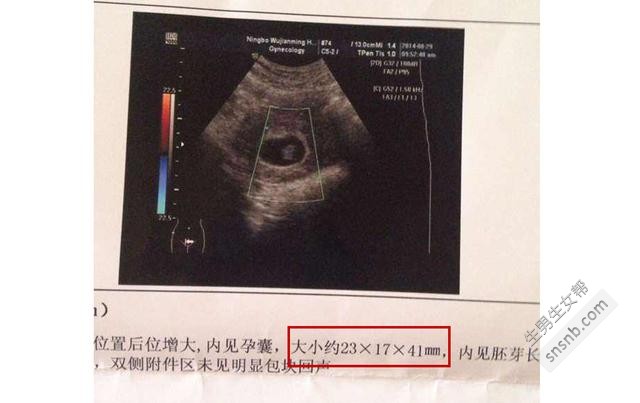 据说可以通过孕囊形状测生男生女，超准哦！