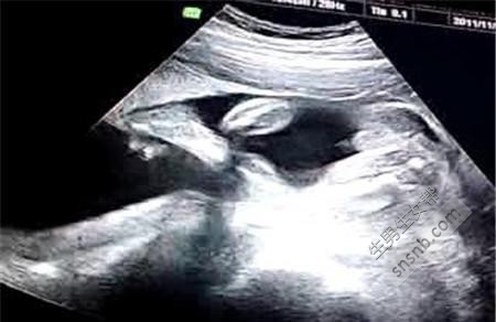 彩超医生教您四维彩超看胎儿性别
