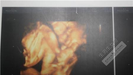 彩超医生教您四维彩超看胎儿性别