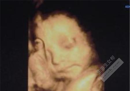 彩超医生教您四维彩超看胎儿性别
