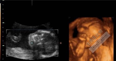 彩超医生教您四维彩超看胎儿性别
