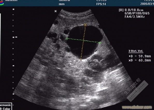 多囊卵巢不怀孕，被村里的人嘲笑是不下蛋的母鸡，终于我怀孕了！