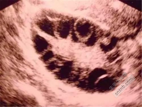 多囊卵巢不怀孕，被村里的人嘲笑是不下蛋的母鸡，终于我怀孕了！